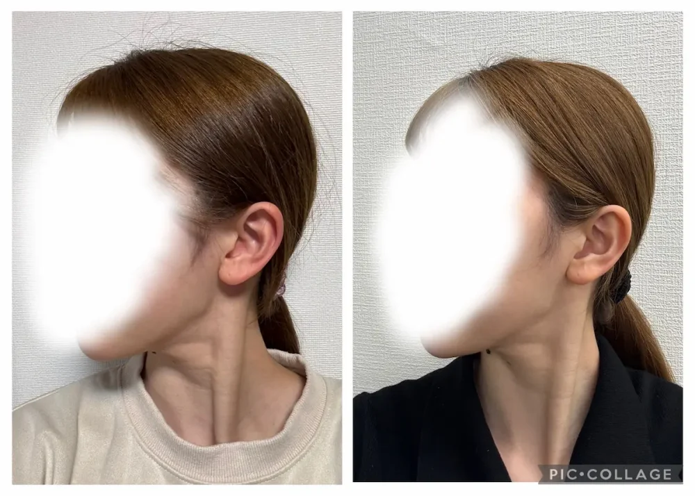 使用前と使用後のフェイスラインの比較