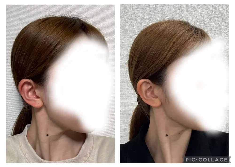 使用前と使用後のフェイスラインの比較